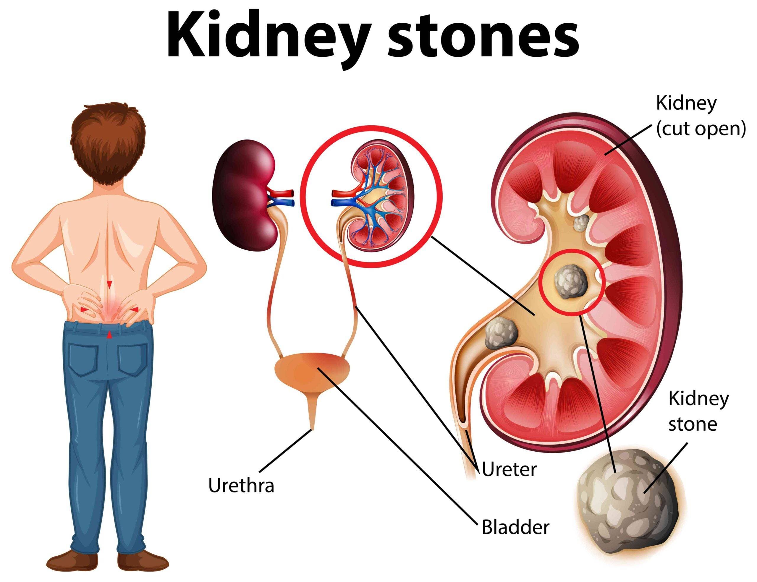 Kidney Stone Illustration via NIH